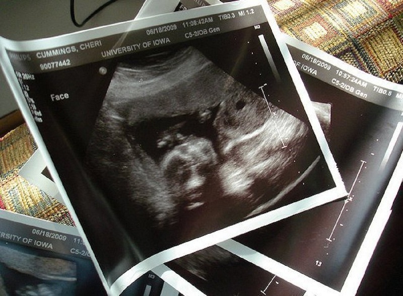 The First Ultrasound: Better after 12 Weeks?