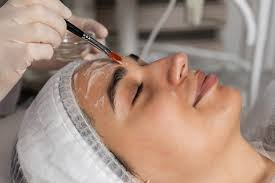 What are the benefits of a chemical peel?